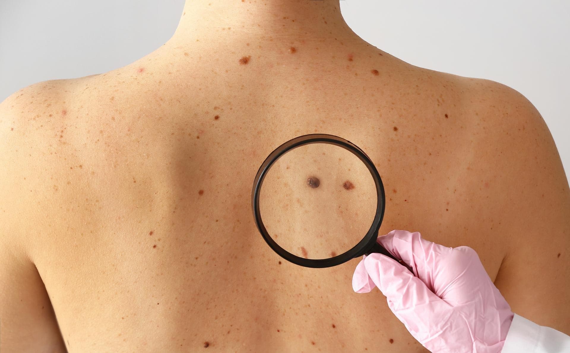 Niacinamide Found to Reduce the Risk of New Skin Cancers